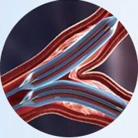 Coronary Dilation Balloon Catheter